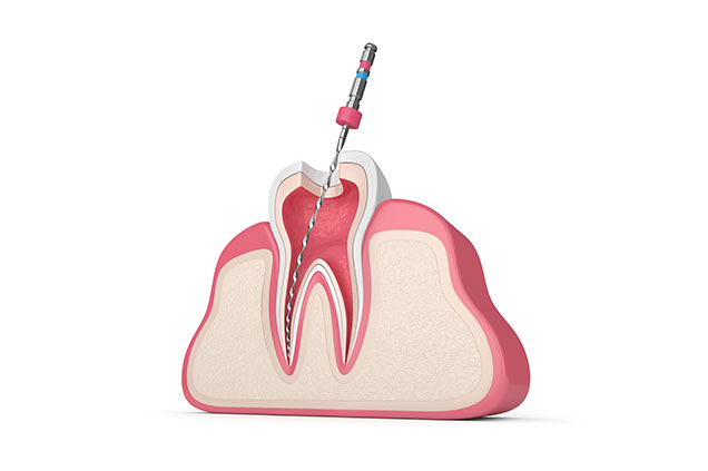Root Canals in Evergreen Park IL